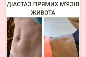 Диастаз прямых мышц живота. Что это?