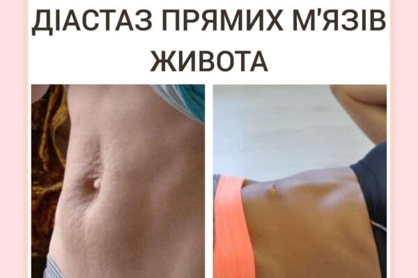 Диастаз прямых мышц живота. Что это?