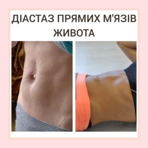 Діастаз прямих м'язів живота. Що це?