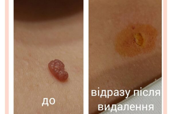 видалення раздічних новоутворень шкіри
